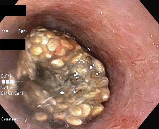 Una imagen del gel adherido al esófago. Foto: American College of Gastroenterology