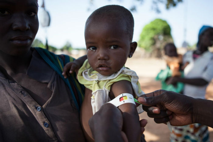 De Acuerdo Con La Unicef La Mitad De Las Muertes De Niños Menores De Cinco Años Esta Asociada Con La Desnutrición Foto Unicef