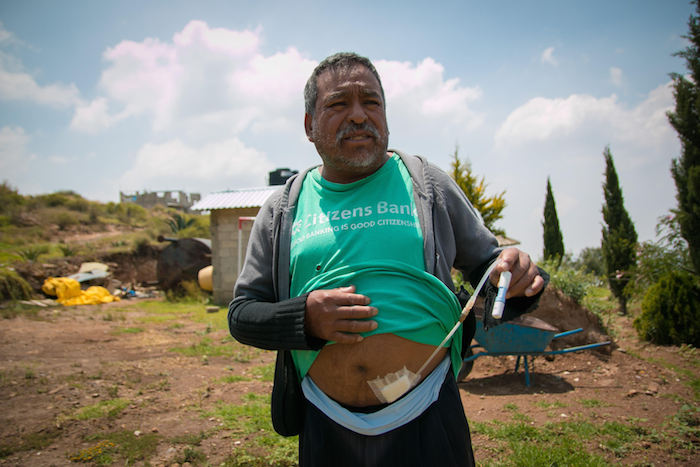 Rodolfo Pérez Jiménez, de 50 años, depende de un catéter de diálisis peritonal que tiene que cambiar tres veces al día. Foto: Xinhua