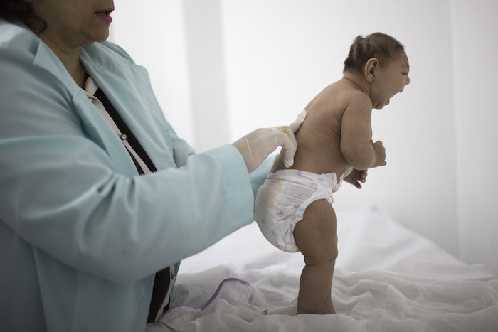 En esta imagen de archivo, tomada el de febrero de 2016, Lara, que tiene menos de 3 meses de edad y que nació con microcefalia, durante un examen con un neurólogo en el hospital Pedro I de Campina Grande, en el estado de Paraiba, Brasil. (Foto AP/Felipe Dana, archivo)