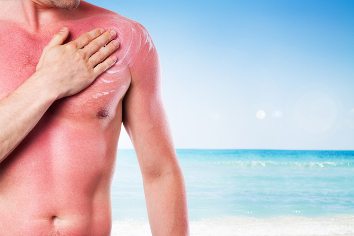 Los Expertos También Recomiendan Evitar Salones Para Broncearse Porque Se Ha Relacionado Las Camas Bronceadoras Con El Aumento De Melanoma Foto Shutterstock