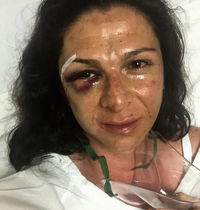 La senadora del Partido del Trabajo Ana Gabriela Guevara, fue golpeada por 4 sujetos cuando viajaba en su motocicleta en la autopista México-Toluca. 