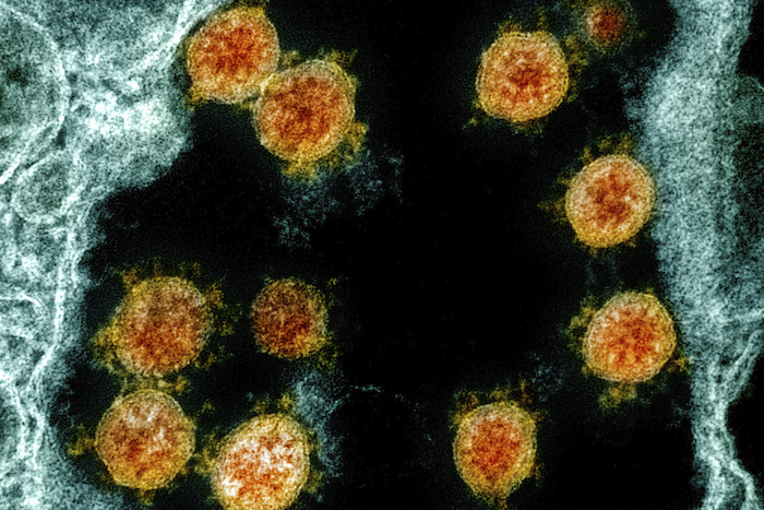 Esta imagen de microscopio proporcionada por el Instituto Nacional de Alergias y Enfermedades Infecciosas en Fort Detrick, Maryland, muestra partículas del nuevo coronavirus SARS-CoV-2 aisladas de un paciente.