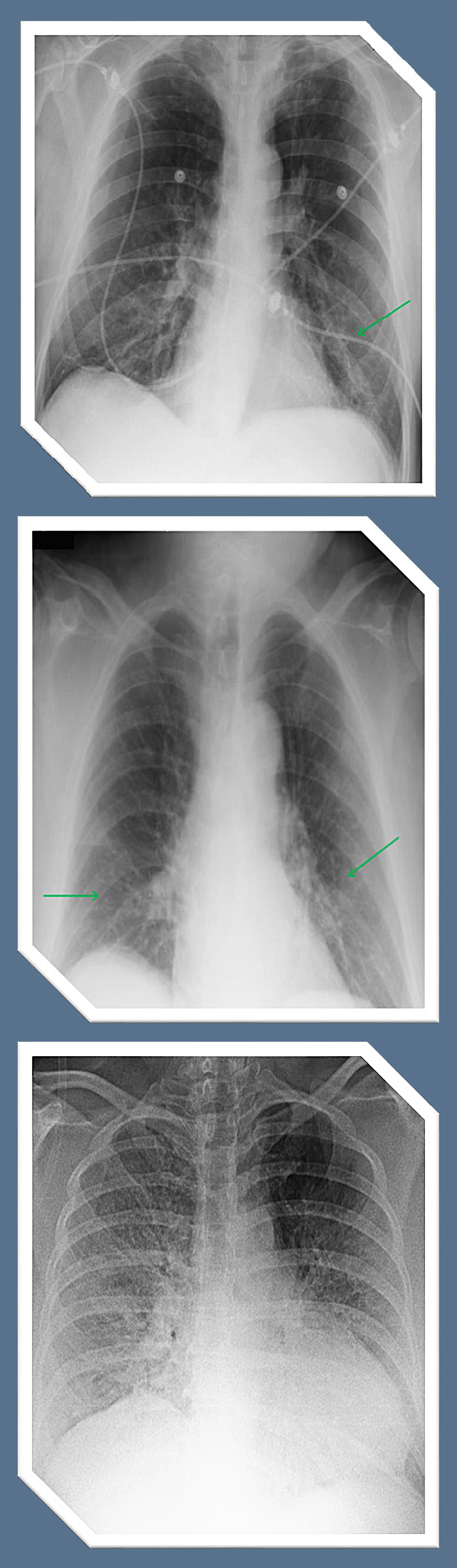 Pulmones