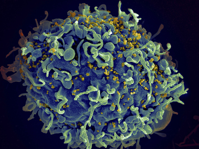 En esta imagen de archivo, distribuida por los Institutos Nacionales de Salud de Estados Unidos, se muestra una célula T humana (en azul) atacada por el VIH (en amarillo), el virus que causa el sida, al microscopio. 