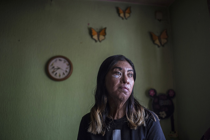 Esmeralda Millán, quien sobrevivió a un ataque con ácido por su expareja hace tres años cuando ella tenía 23 años, posa para un retrato en la casa de su abuela en el estado de Puebla, México, el martes 22 de junio de 2021. El atacante de Millán fue arrestado y encarcelado bajo cargos de intento de feminicidio el mismo año del ataque.